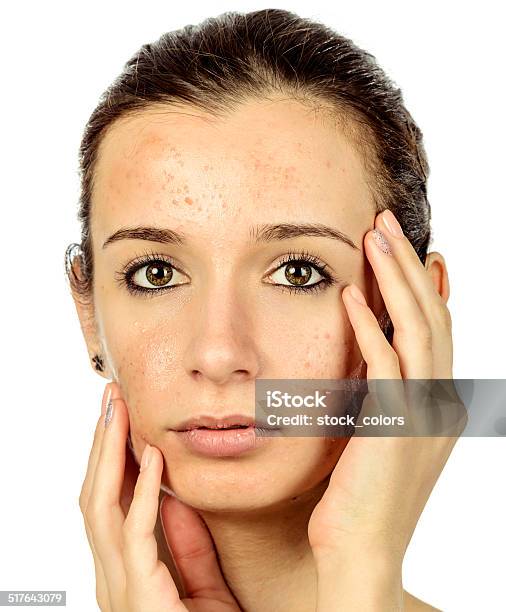 Teenager Problems Stock Photo - Download Image Now - Acne, Teenager, 18-19 Years