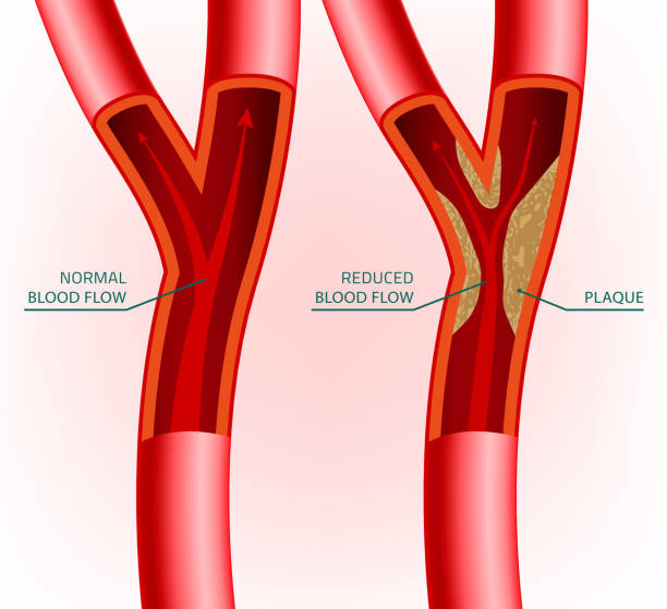 вена крови изображение - human artery cholesterol atherosclerosis human heart stock illustrations