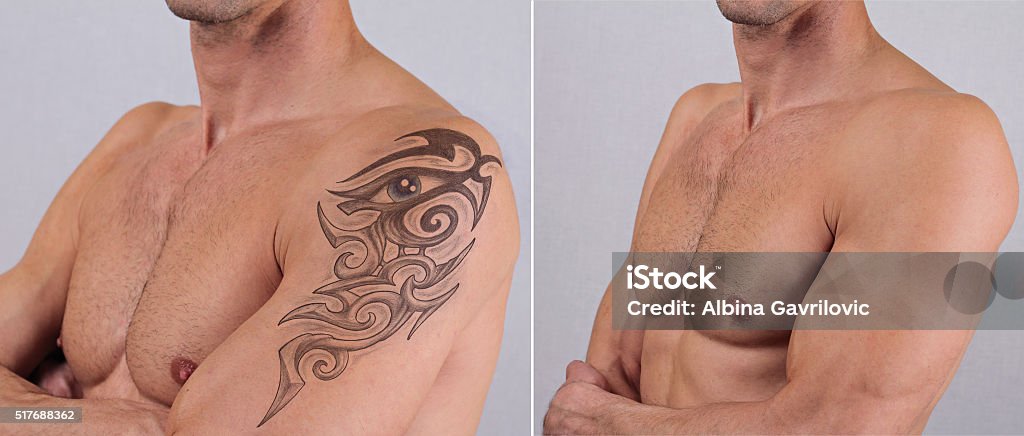Laser Tattoo Removal Before And After Stock Photo - Download Image Now -  Tattoo, Removing, Medical Laser - iStock