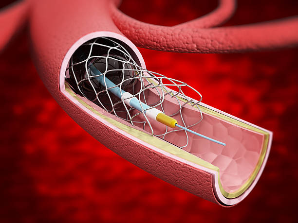 혈관 스텐트의 정맥 내부에서 - angioplasty 뉴스 사진 이미지