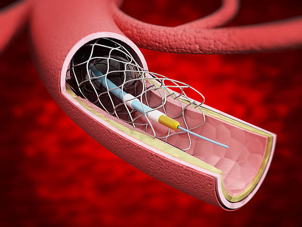 Vascular stent inside the vein Detailed illustration showing vascular stent inside the vein. aorta photos stock pictures, royalty-free photos & images