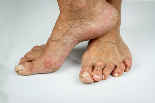 Rheumatoid arthritis feet. Cracked toe skin