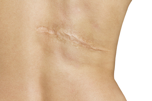 Scar after operation on back of women on white background