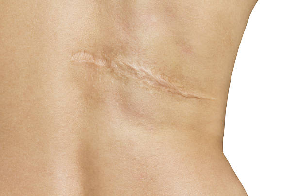 Scar after operation on back of women on white background Scar after operation on back of women on white background scarification stock pictures, royalty-free photos & images