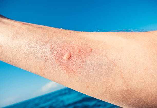 Jellyfish Sting Allergy on the skin after the jellyfish sting. stinging stock pictures, royalty-free photos & images