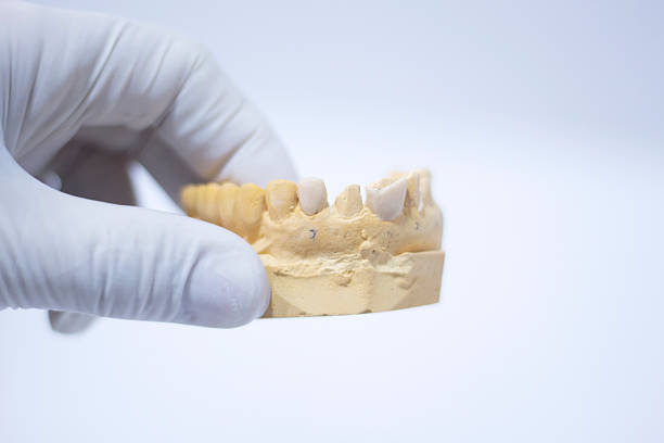 istock Dentist's dental tooth mold 518232188