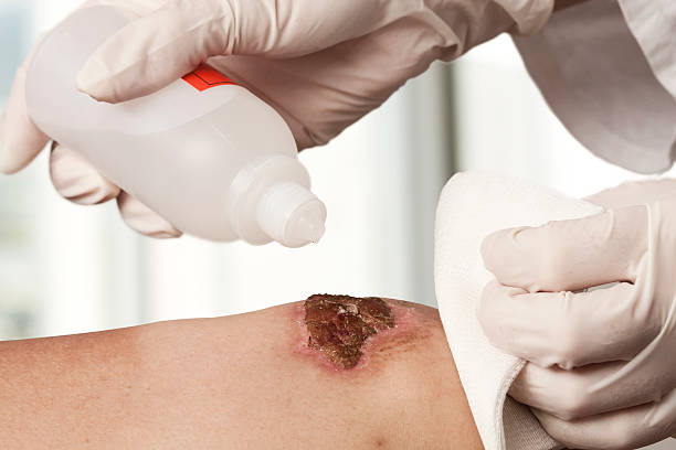 Disinfecting the wound Medical assistant changes the dressing of a wound at the emergency room gas mark stock pictures, royalty-free photos & images