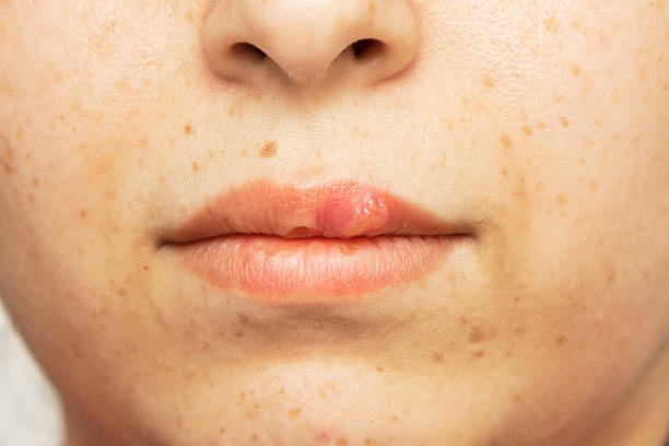 istock herpes oral cold sore blisters on the lips- herpes simplex 518454853