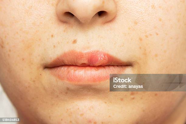 Herpes Oral Cold Sore Blisters On The Lips Herpes Simplex Stock Photo - Download Image Now