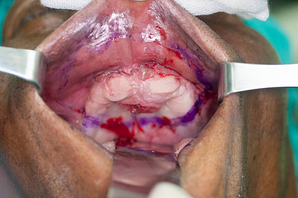 istock Tissue in the mouth 518471451