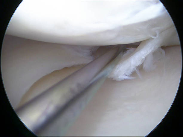 istock Arthroscopic view of a torn medial meniscus probed with hook 518502547