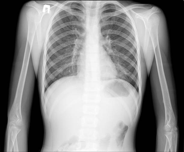 istock X-ray of human chest 518552622