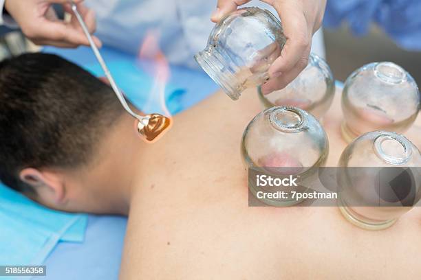 Cupping Therapy In Traditional Chinese Medicine Stock Photo - Download Image Now - Vacuum Cupping, Chinese Culture, Chinese Herbal Medicine