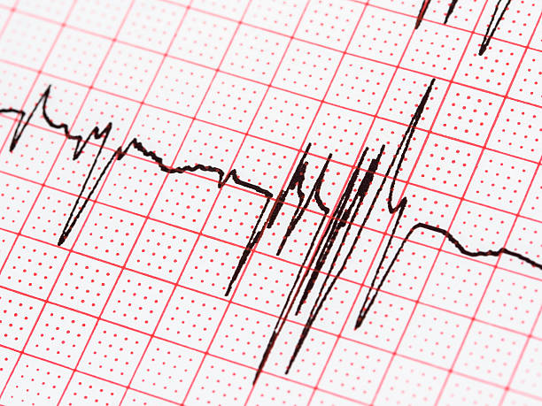 istock Extrasystole On Electrocardiogram Paper 518561930