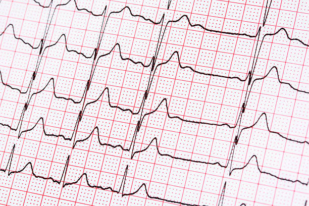 istock Extrasystole On Electrocardiogram Paper 518562016
