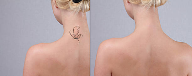 laser tatuagem remoção, antes e depois. - tattoo women back rear view - fotografias e filmes do acervo