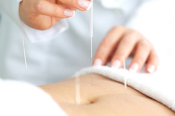 Abdominal acupuncture Doctor applying acupuncture on a patient's abdomen acupuncture photos stock pictures, royalty-free photos & images