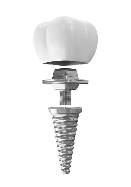 Tooth Implant isolated on white background stock photo