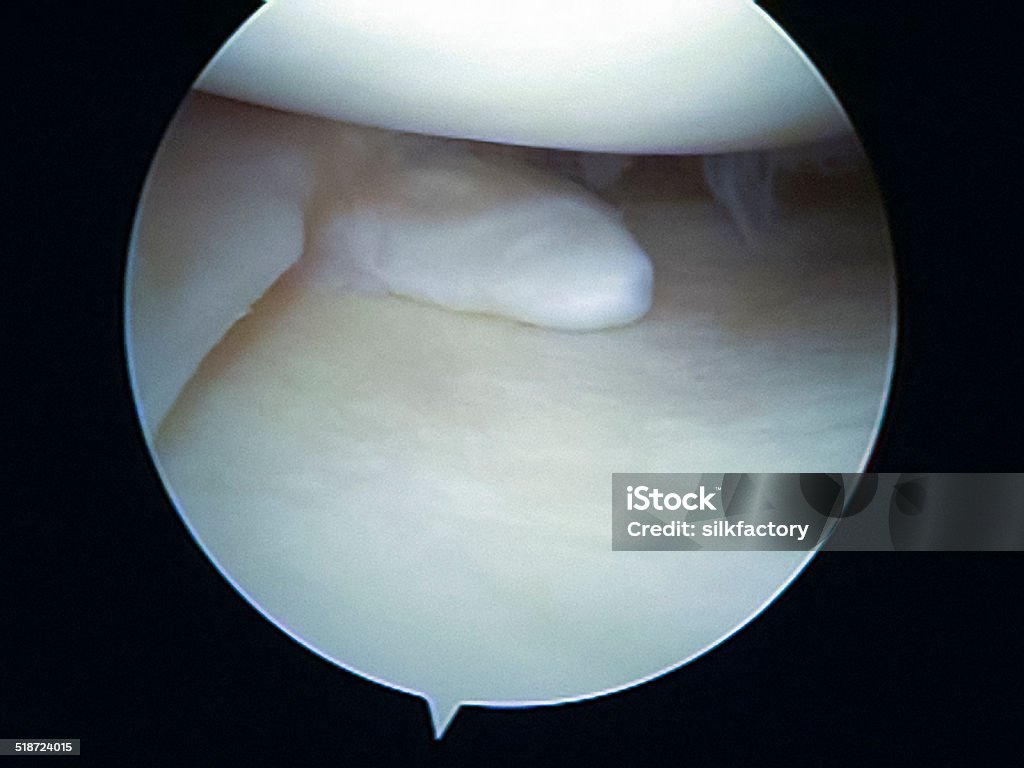 Arthroscopic view of chronic flap tear of the medial meniscus Arthroscopic view of a chronic flap tear of the medial meniscus of the left knee causing pain and catching. Such an injury is often caused by a trauma and is treated with removal of the torn piece of cartilage. Anatomy Stock Photo