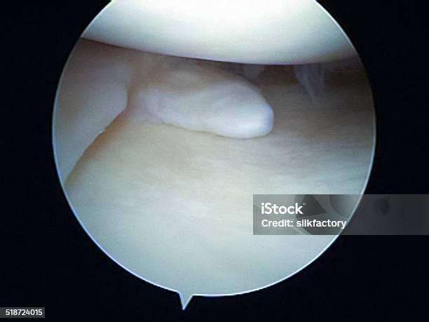 Arthroscopic View Of Chronic Flap Tear Of The Medial Meniscus Stock Photo - Download Image Now