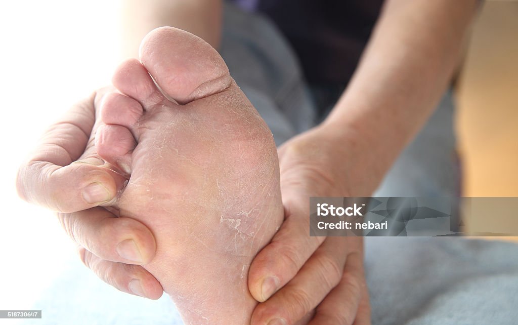 Man with athletes foot itchy skin A man checks the dry, peeling skin of his athletes foot fungus between his toes. Athlete's Foot Stock Photo