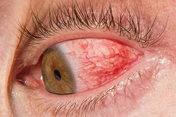 istock Red eye due to allergy 518757476
