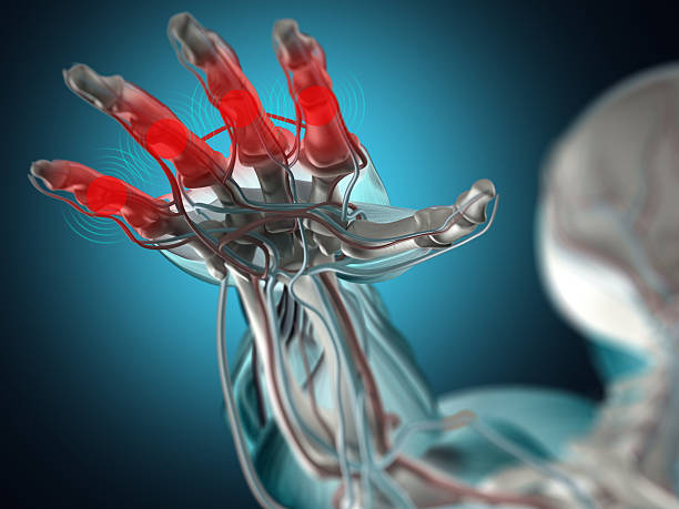 Arthritis in fingers or hand. Anatomy 3D illustration. stock photo
