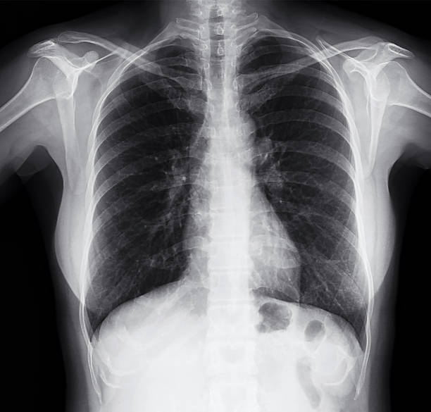 Chest X-ray Image of Women X-Ray image of the human chest female rib cage stock pictures, royalty-free photos & images