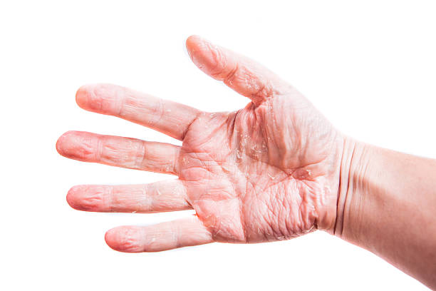 istock The problem with many people - eczema on hand. Isolated 518898734