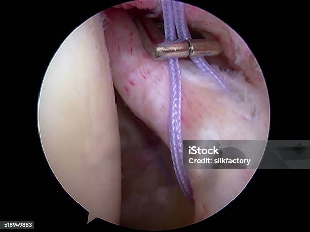 Arthroscopic View Of Shoulder During Repair Of Slap Ii Lesion Stock Photo - Download Image Now