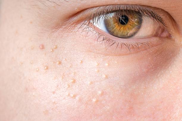 Milia (Milium) - pimples around eye on skin. stock photo