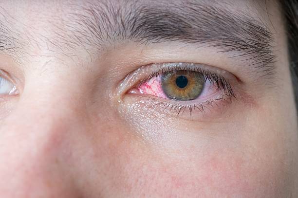 istock Man with red injured eye. 519168054