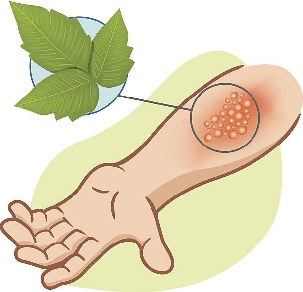 First Aid arm with allergies and rashes Poison Ivy Plant Illustration representing first aid arm with allergy and allergic rashes due to poison ivy poisoning leaf epidermis stock illustrations