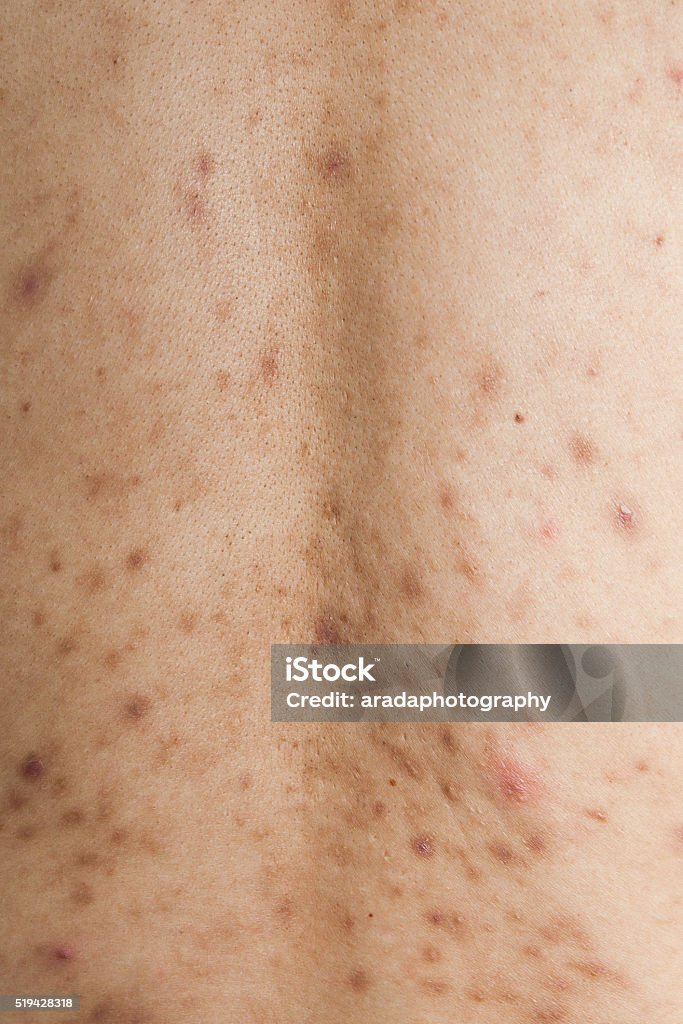 Boy Rash Back Boy With Problematic Skin And Acne Scars In The Back Stock Photo ...