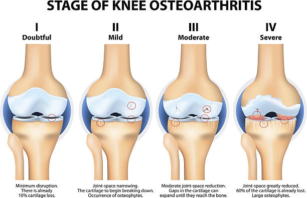 illustrazioni stock, clip art, cartoni animati e icone di tendenza di fasi "osteoartrite (oa) delle ginocchia. - pain human knee arthritis human joint