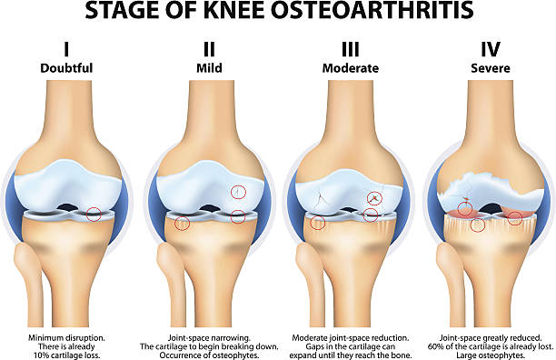 Stages of knee Osteoarthritis (OA). Stages of knee Osteoarthritis (OA). Kellgren and Lawrence criteria for assessment stage of osteoarthritis. The classifications are based on osteophyte formation and joint space narrowing. knee pain stock illustrations