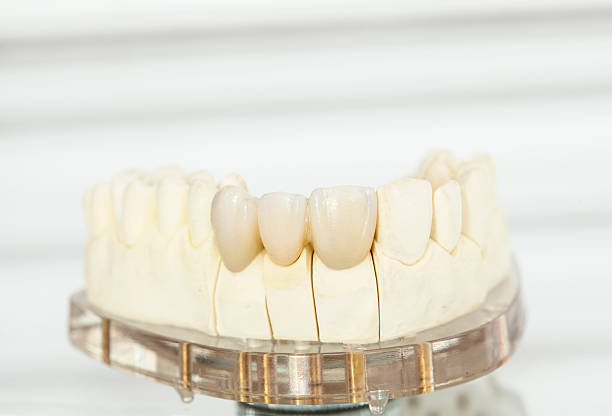 istock Metal free ceramic dental crowns 519574262
