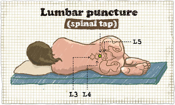 Spinal Puncture Illustration stock photo