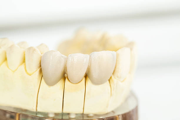 istock Metal free ceramic dental crowns 519682140
