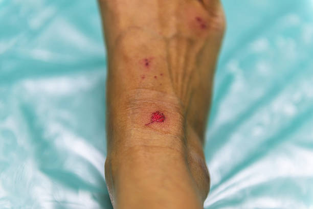 istock Soft focus and background blur patients with lesions caused 519709518