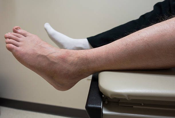 fractura do pé, torcido tornozelo, fracturado osso na sala de exame médico - podiatrist podiatry orthopedic surgeon human foot imagens e fotografias de stock