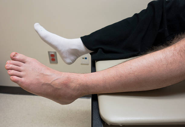 fractura do pé, torcido tornozelo, fracturado osso na sala de exame médico - podiatrist podiatry orthopedic surgeon human foot imagens e fotografias de stock