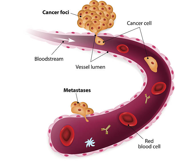 Cancer cells, cancer foci and Metastases Cancer cell squeezes through blood vessel during Metastases human artery stock illustrations