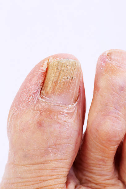 istock Toe Nail Fungus 520044717
