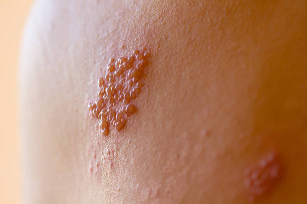 Shingles on men herpes zoster. Closeup. stock photo