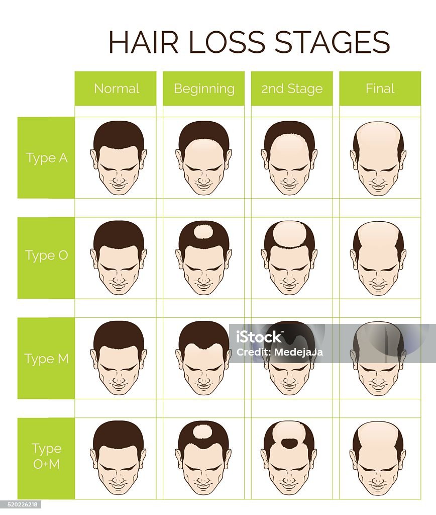 Hair Loss Stages And Types For Men Stock Illustration - Download Image Now  - Male Likeness, Pattern, Balding - iStock