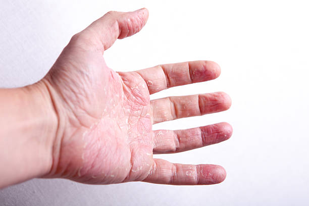istock allergic rash dermatitis skin texture of patient 520231070