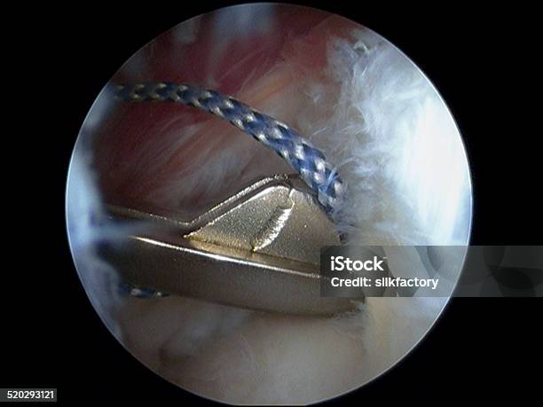 Arthroscopic Suture Passing Device In Rotator Cuff Repair In Shoulder Stock Photo - Download Image Now