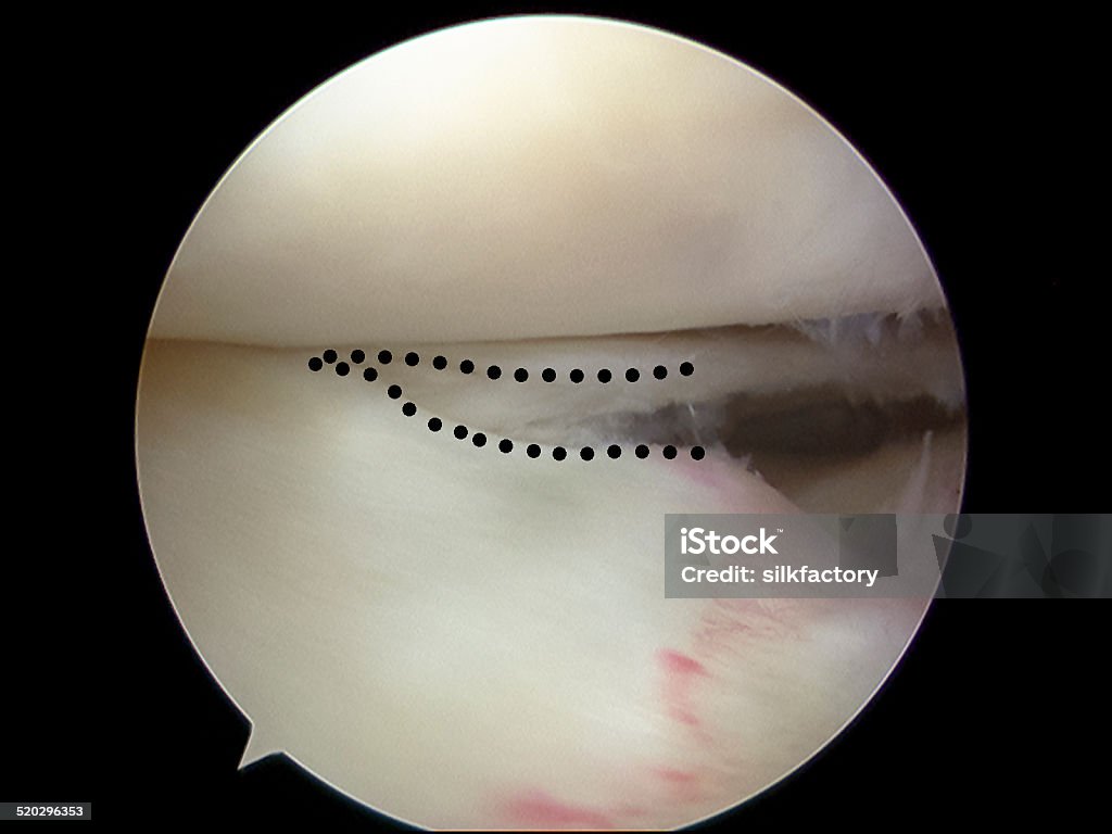 Arthroscopic view of a radial tear of the lateral meniscus Arthroscopic view of a radial tear (dotted line) of the lateral meniscus of the right knee causing pain, swelling and catching. Anatomy Stock Photo