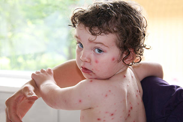 Sick child with chickenpox, sad girl. stock photo